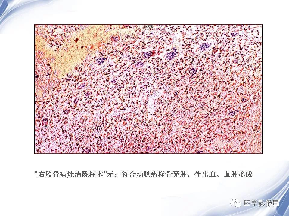 【PPT】动脉瘤样骨囊肿的影像学分析