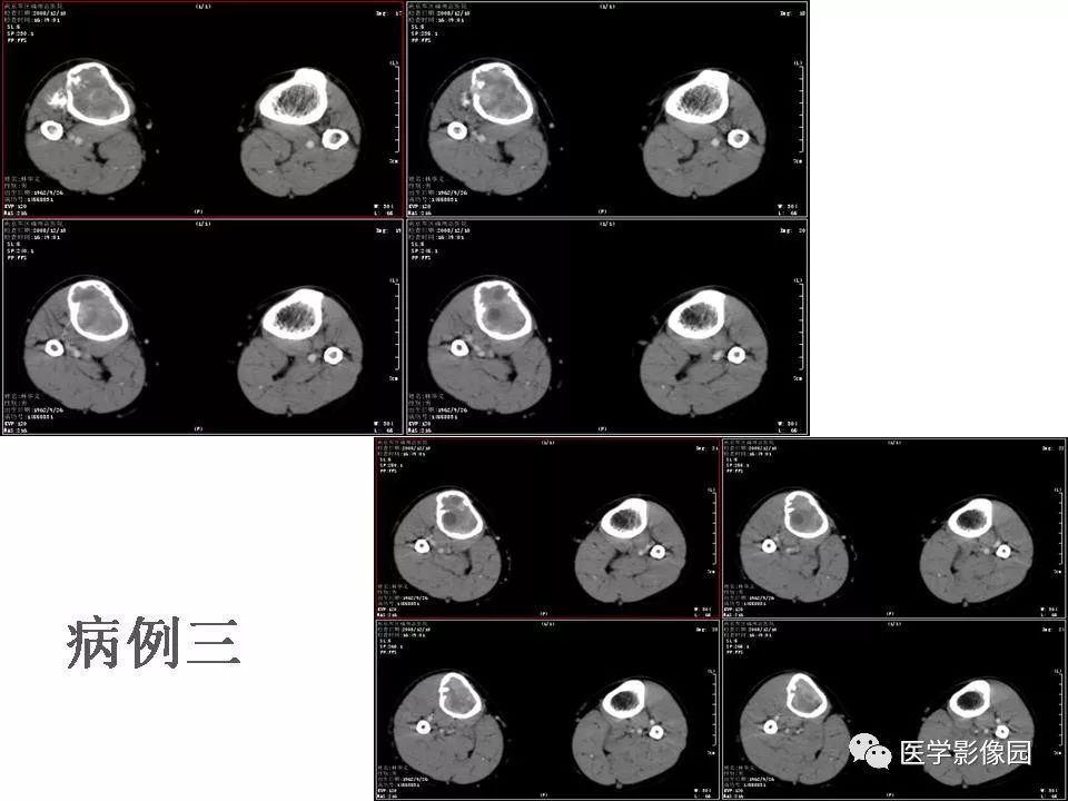 【PPT】动脉瘤样骨囊肿的影像学分析