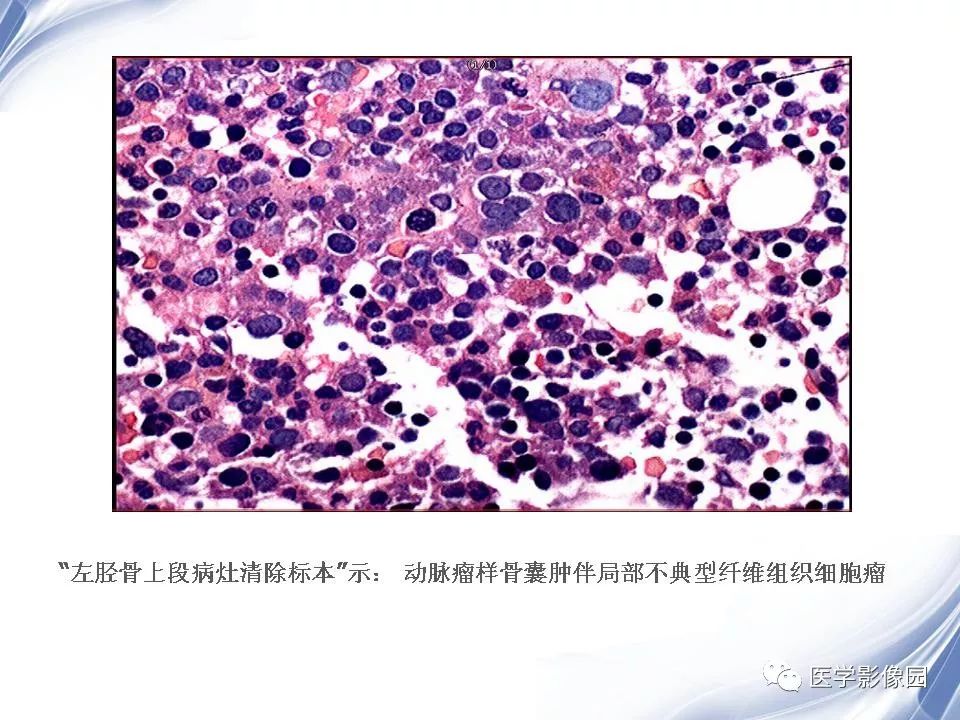 【PPT】动脉瘤样骨囊肿的影像学分析