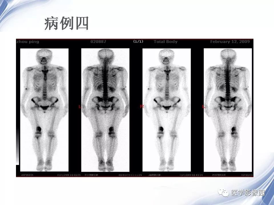 【PPT】动脉瘤样骨囊肿的影像学分析