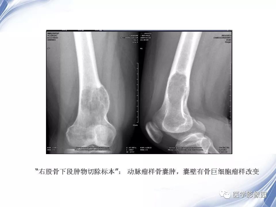 【PPT】动脉瘤样骨囊肿的影像学分析
