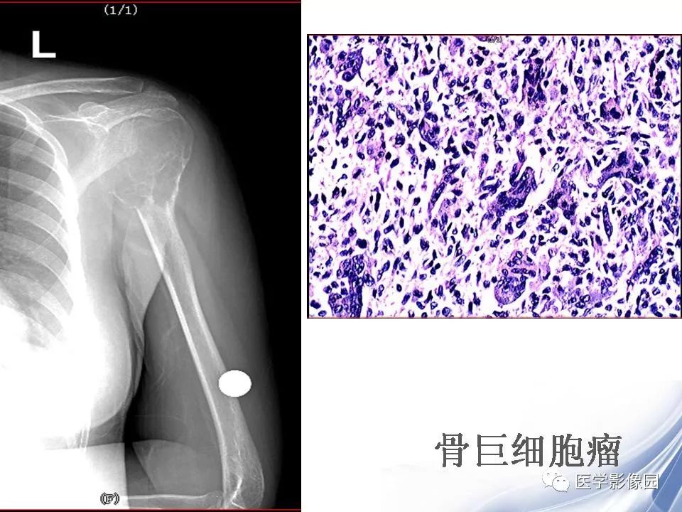 【PPT】动脉瘤样骨囊肿的影像学分析