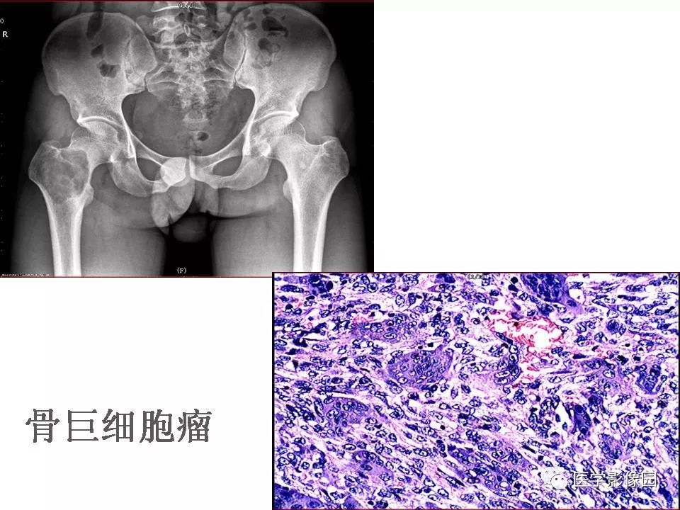 【PPT】动脉瘤样骨囊肿的影像学分析