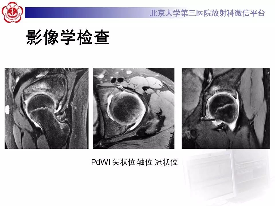 【病例】髂腰肌撞击1例MR影像表现