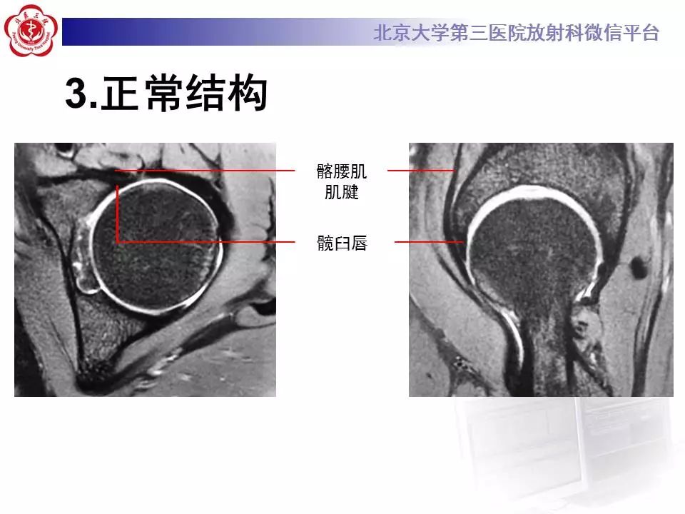 【病例】髂腰肌撞击1例MR影像表现
