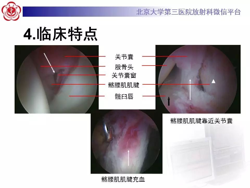 【病例】髂腰肌撞击1例MR影像表现