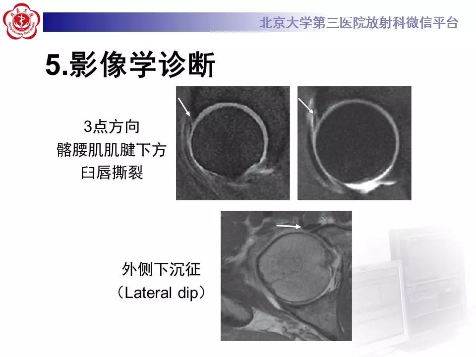 【病例】髂腰肌撞击1例MR影像表现