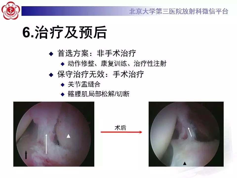 【病例】髂腰肌撞击1例MR影像表现