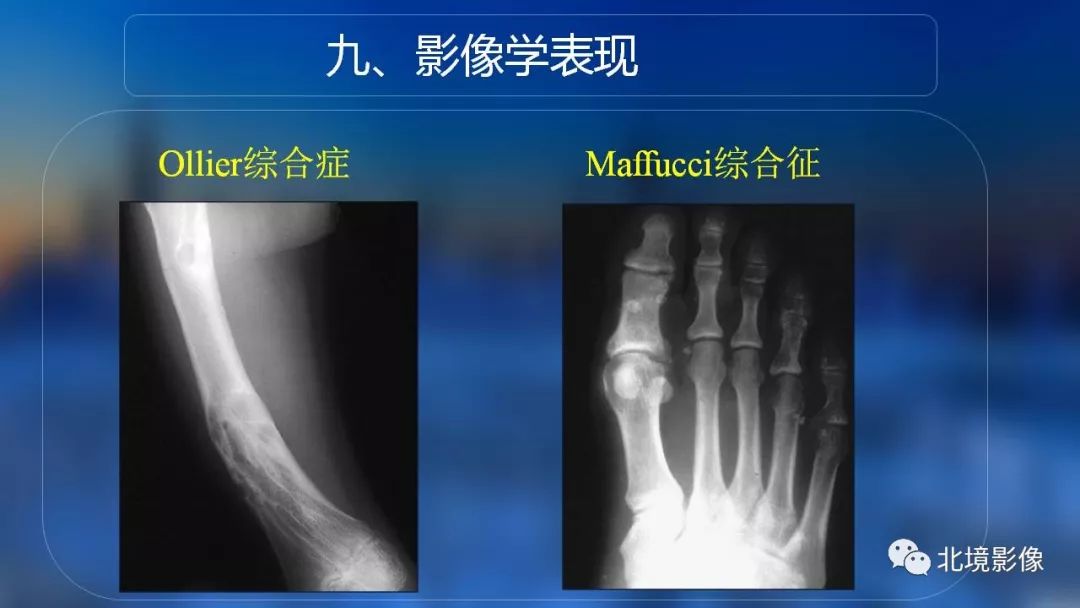 【PPT】内生性软骨瘤影像诊断