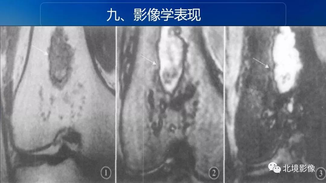 【PPT】内生性软骨瘤影像诊断