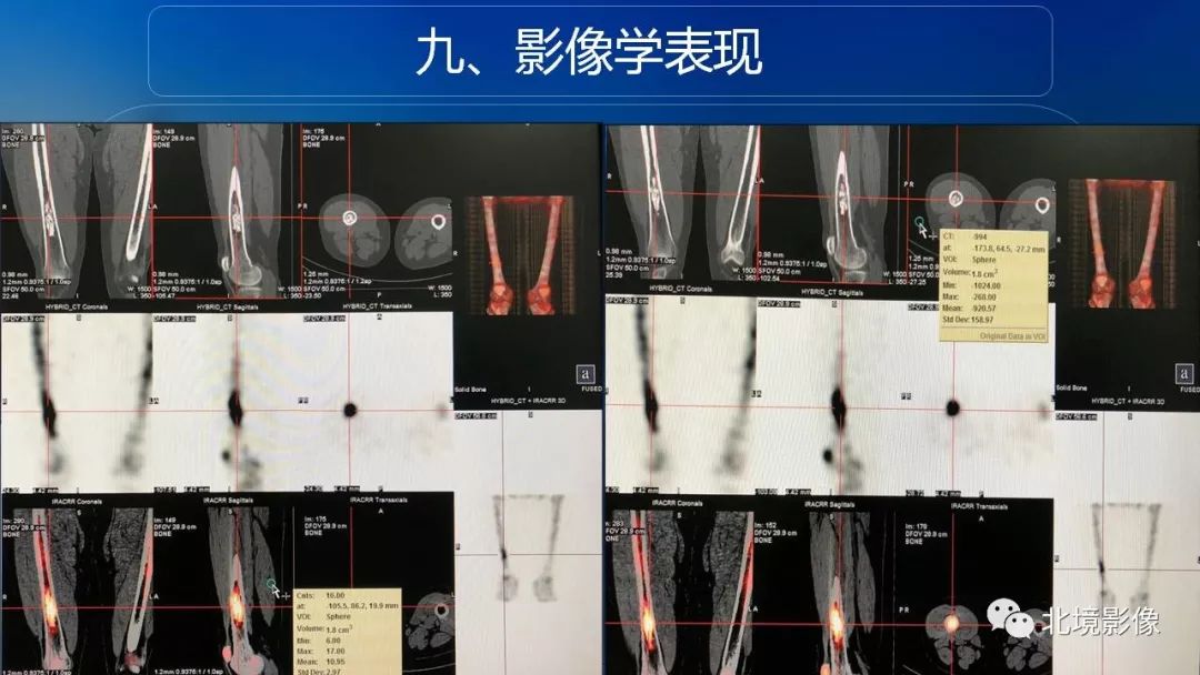 【PPT】内生性软骨瘤影像诊断