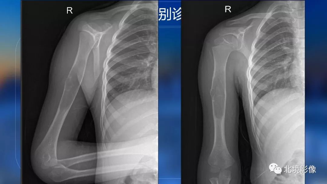 【PPT】内生性软骨瘤影像诊断