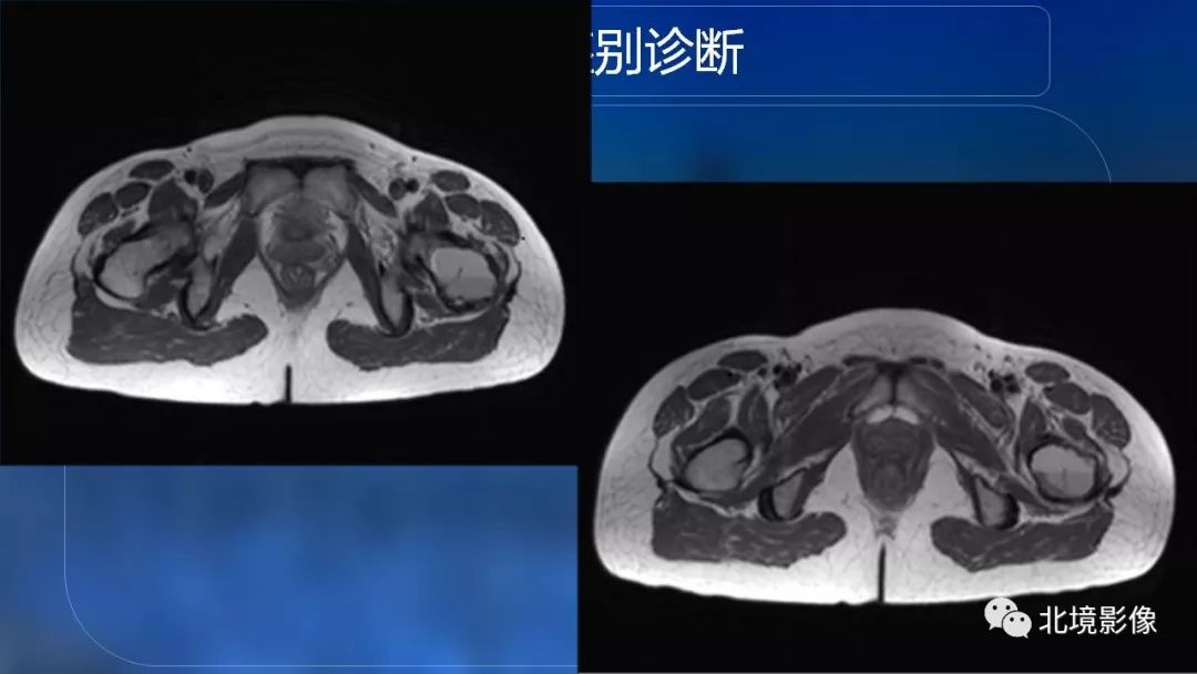 【PPT】内生性软骨瘤影像诊断