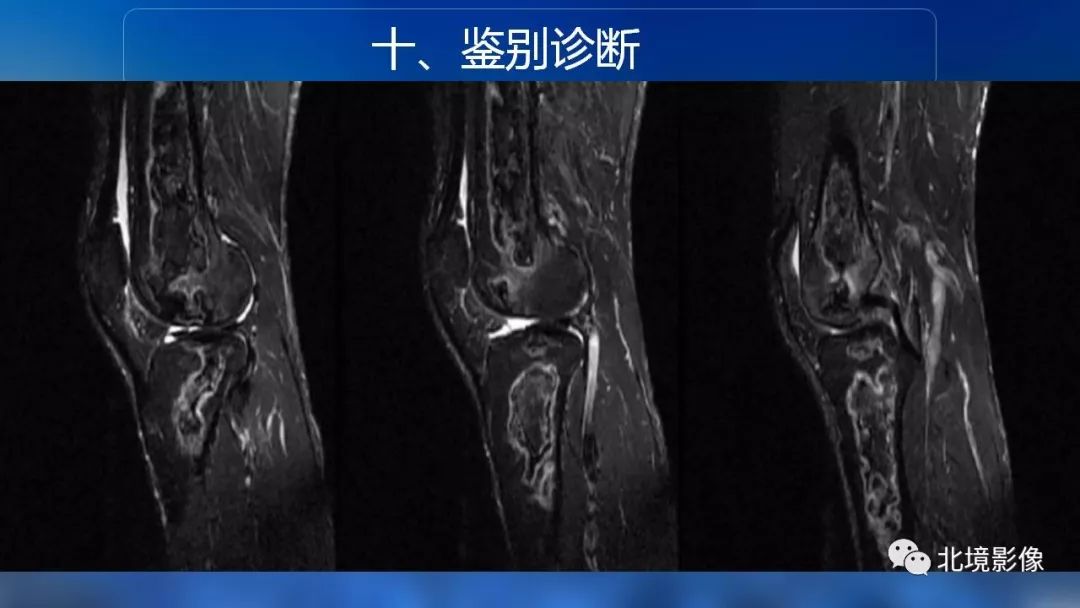 【PPT】内生性软骨瘤影像诊断