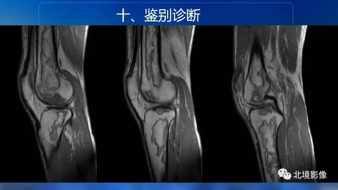 【PPT】内生性软骨瘤影像诊断
