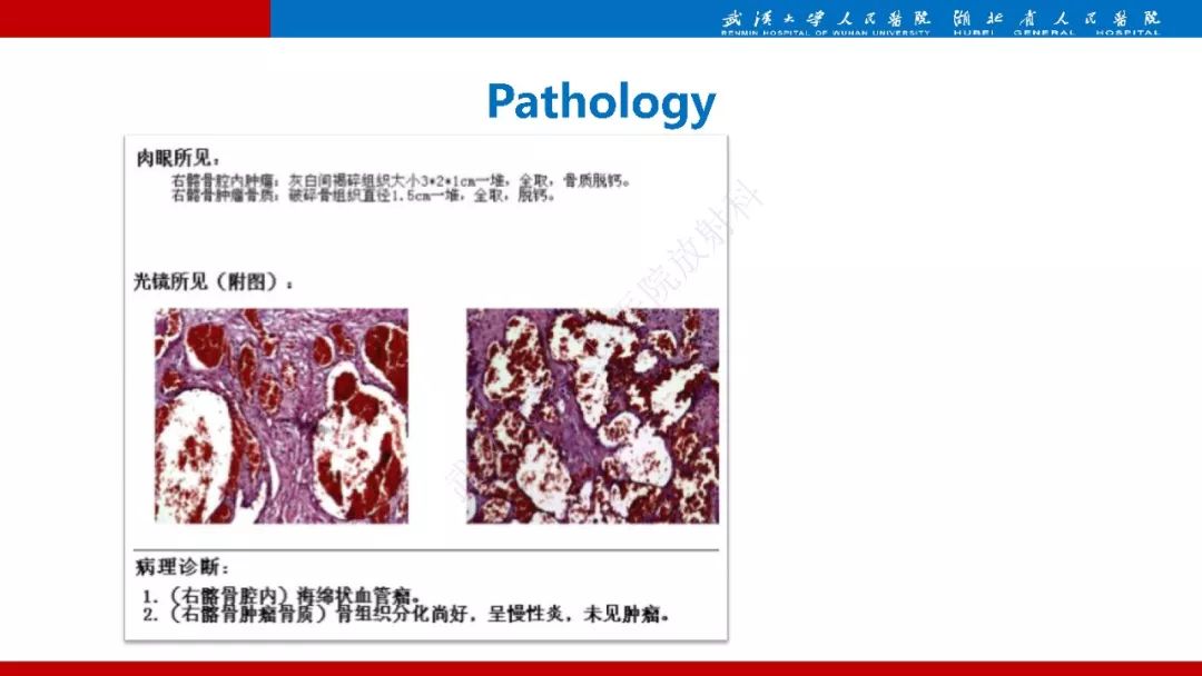 【PPT】髂骨海绵状血管瘤影像诊断