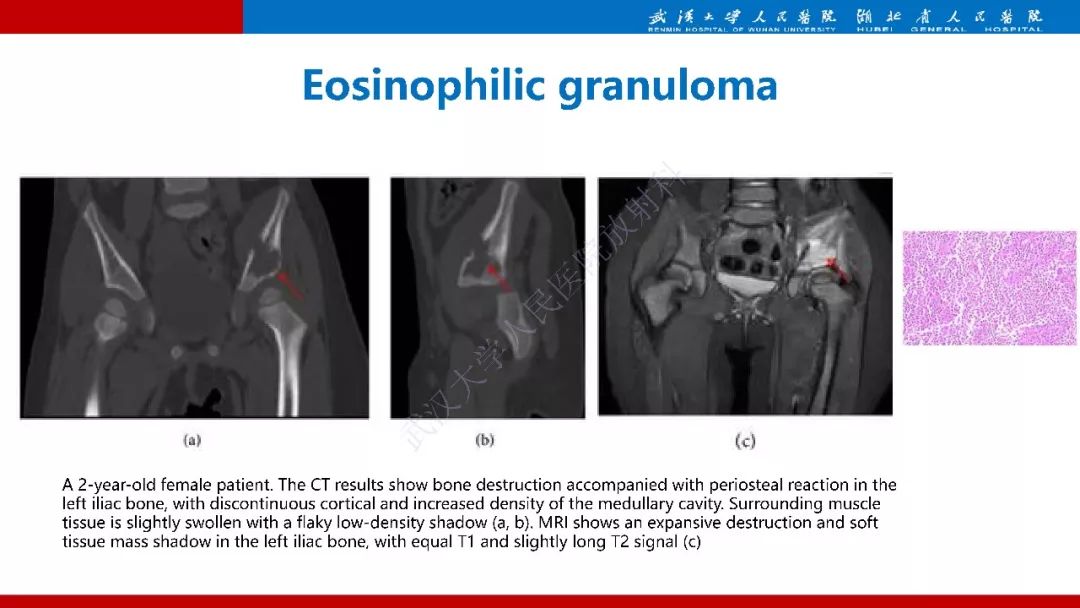 【PPT】髂骨海绵状血管瘤影像诊断