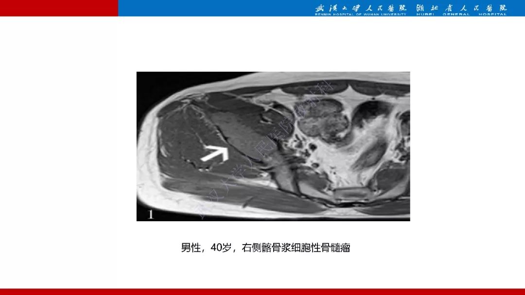 【PPT】髂骨海绵状血管瘤影像诊断