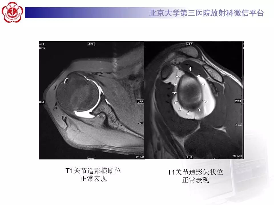 【PPT】肩关节MR造影正常表现