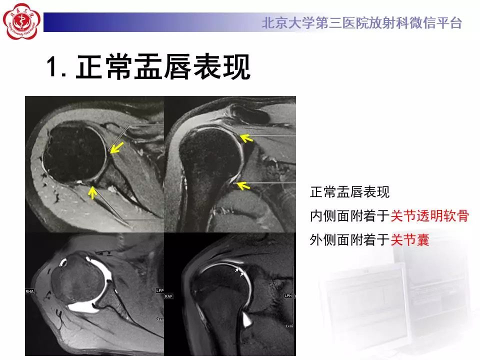 【PPT】肩关节MR造影正常表现