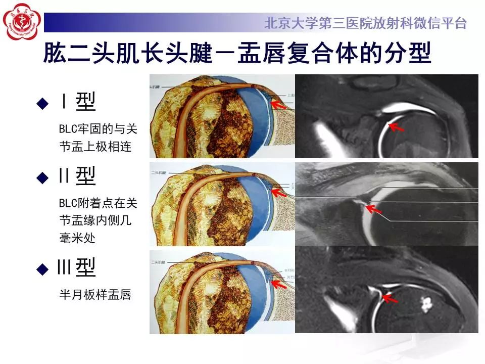 【PPT】肩关节MR造影正常表现