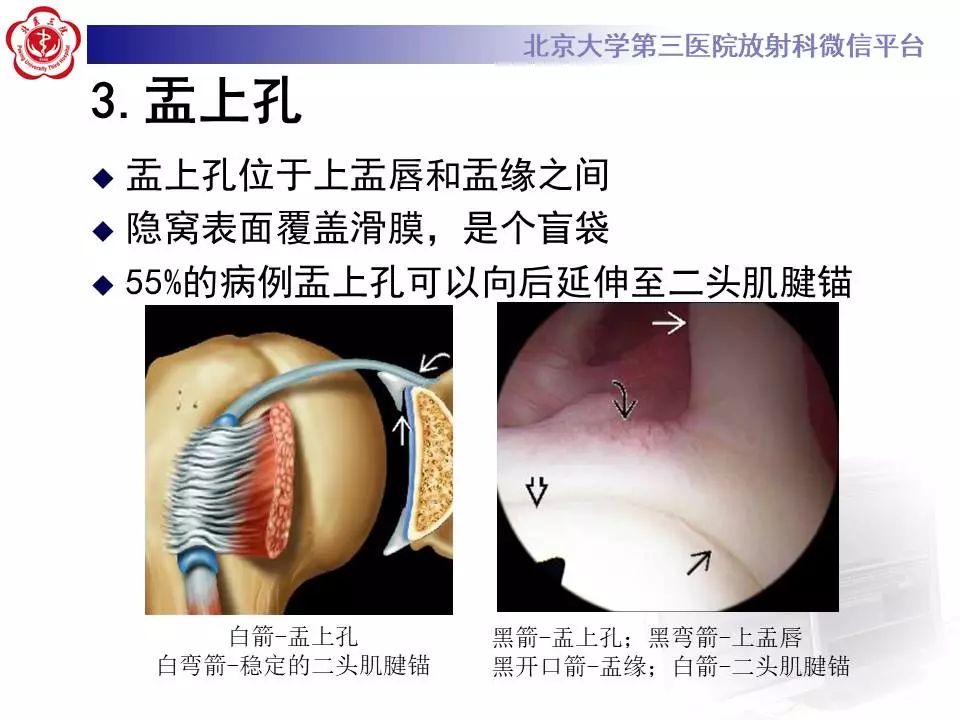 【PPT】肩关节MR造影正常表现