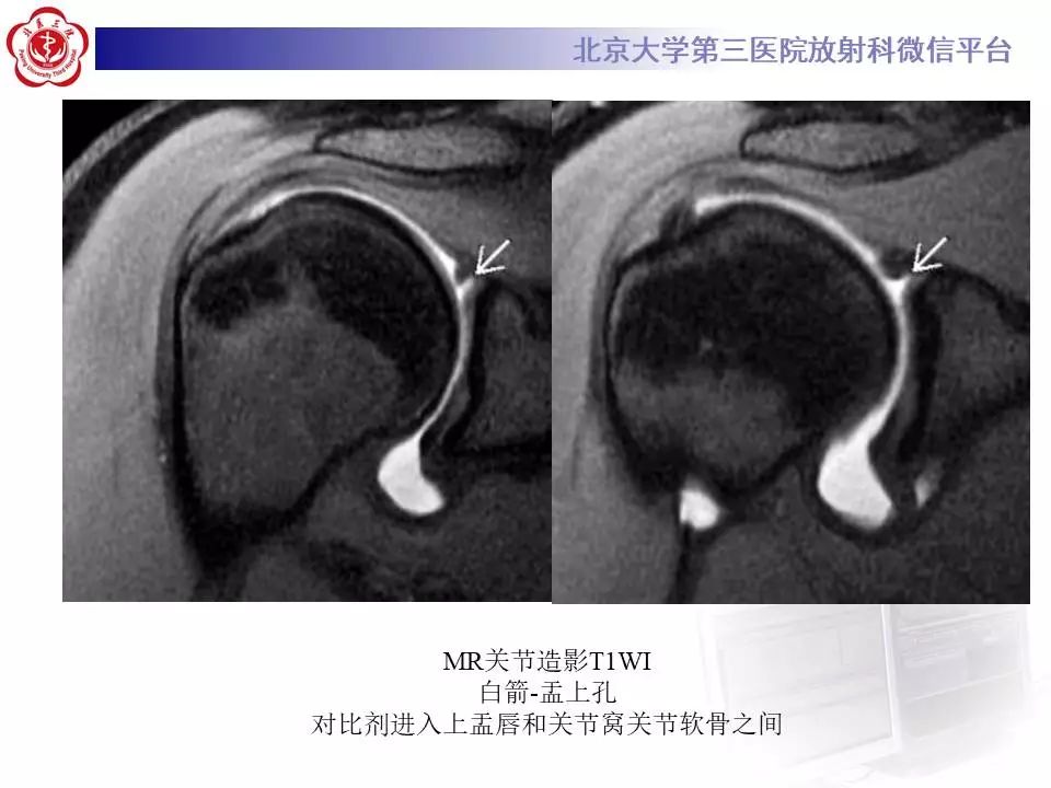 【PPT】肩关节MR造影正常表现