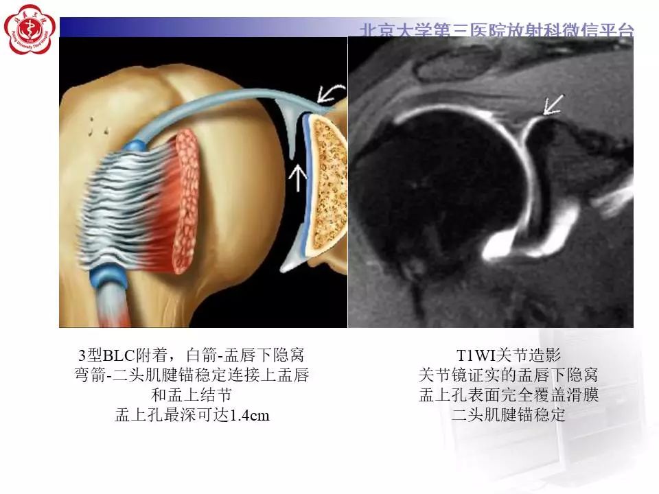 【PPT】肩关节MR造影正常表现