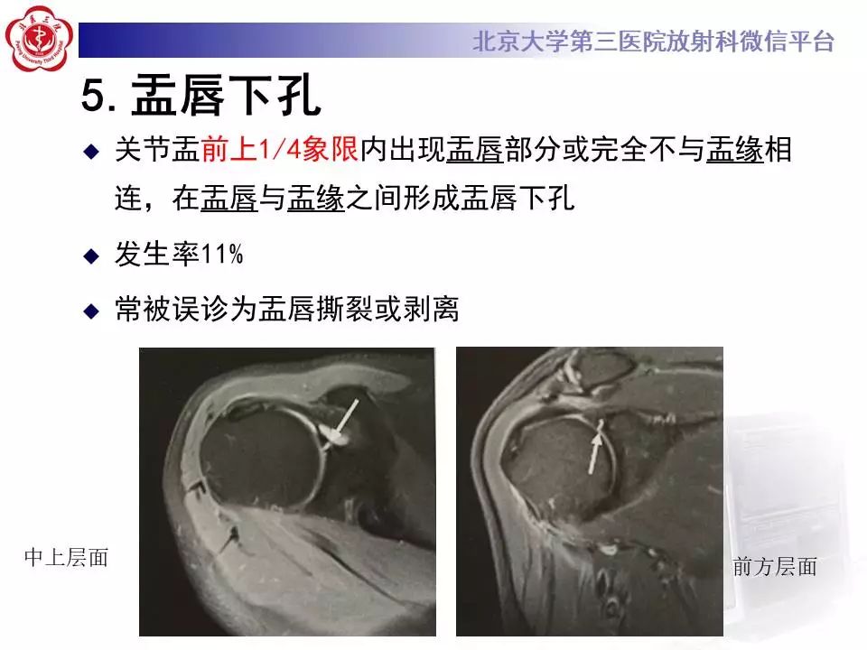 【PPT】肩关节MR造影正常表现
