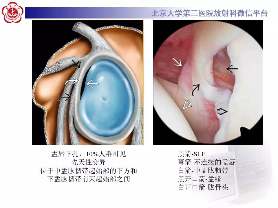 【PPT】肩关节MR造影正常表现