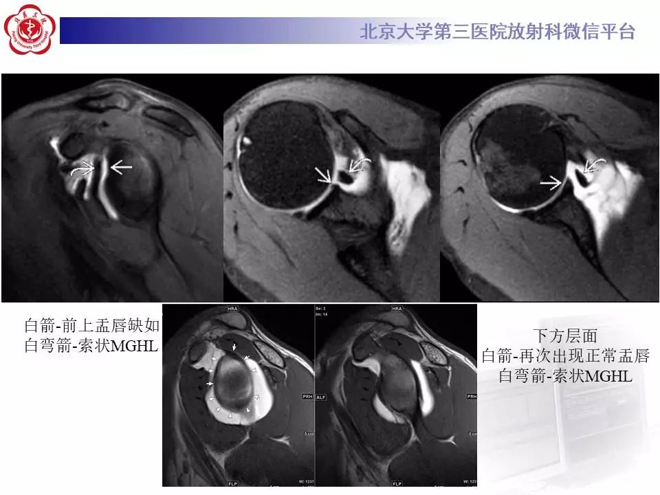 【PPT】肩关节MR造影正常表现