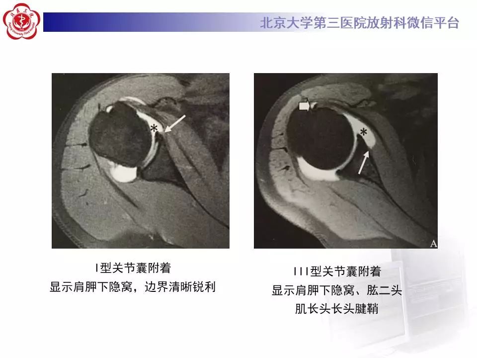 【PPT】肩关节MR造影正常表现