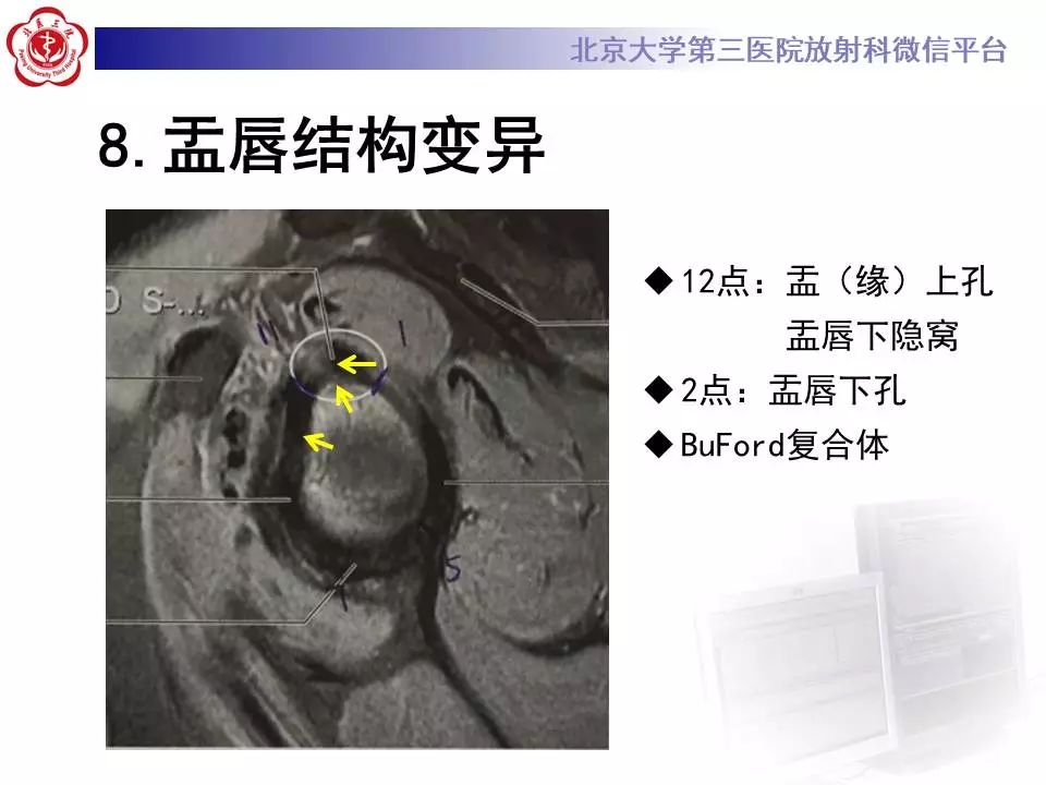 【PPT】肩关节MR造影正常表现