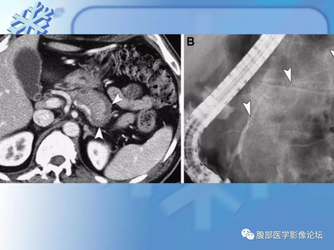 【PPT】自身免疫性胰腺炎