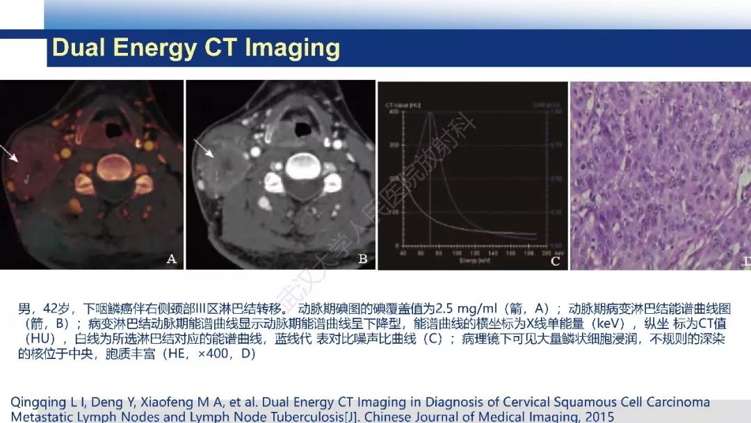 【PPT】颈部良恶性淋巴结影像学鉴别