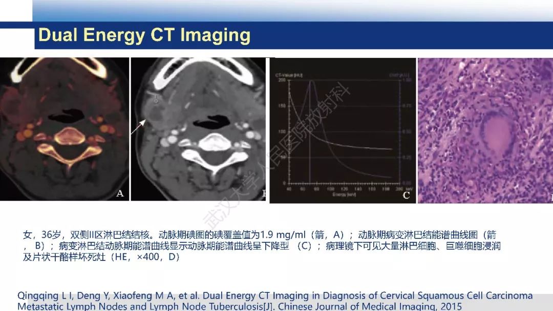 【PPT】颈部良恶性淋巴结影像学鉴别
