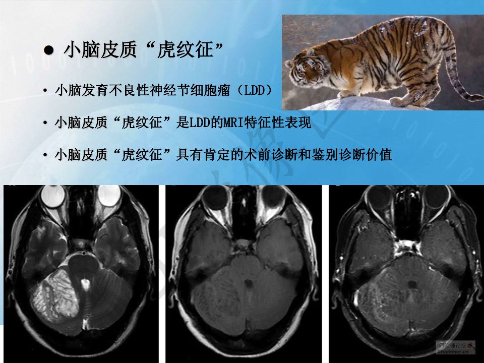 【PPT】小脑皮质“虎纹征”