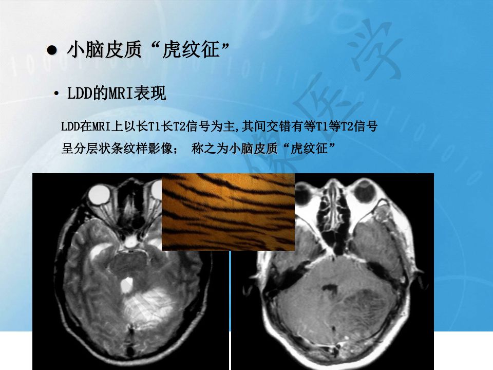 【PPT】小脑皮质“虎纹征”