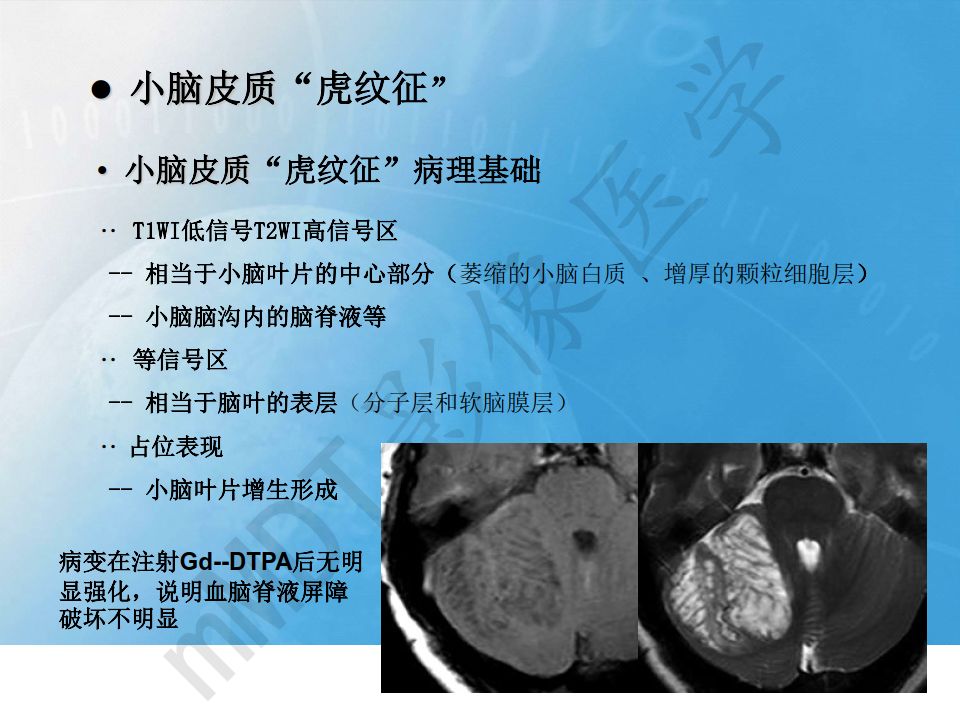 【PPT】小脑皮质“虎纹征”