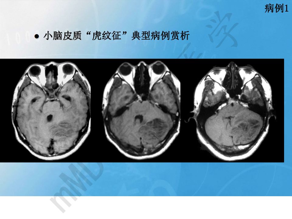 【PPT】小脑皮质“虎纹征”