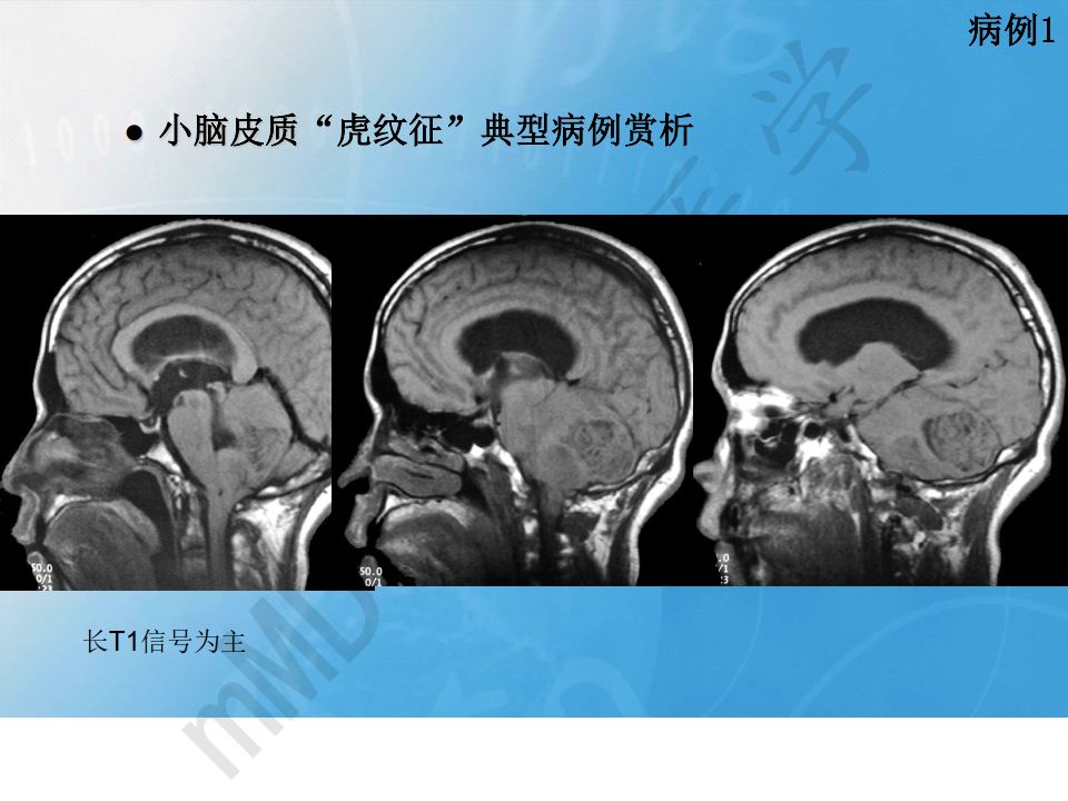 【PPT】小脑皮质“虎纹征”