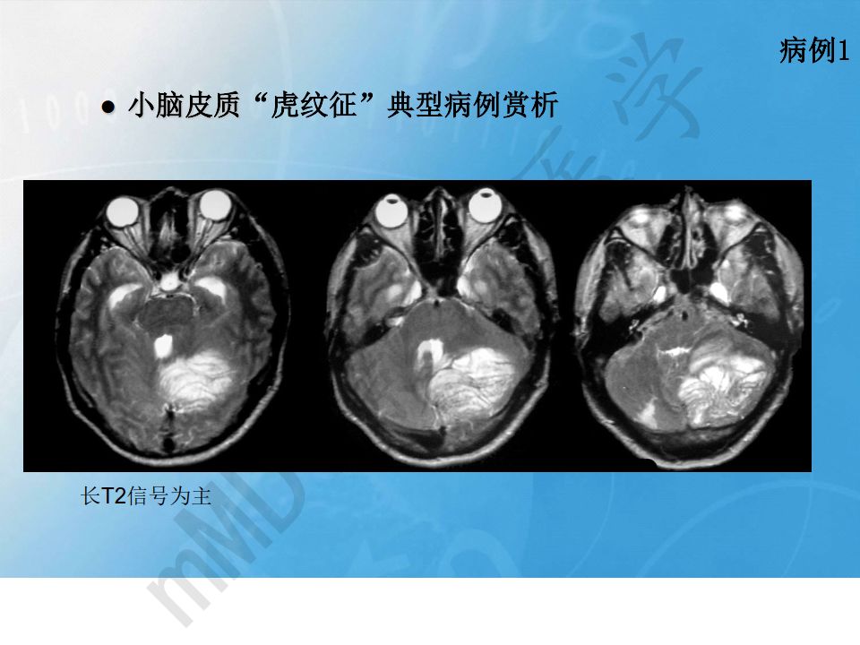 【PPT】小脑皮质“虎纹征”