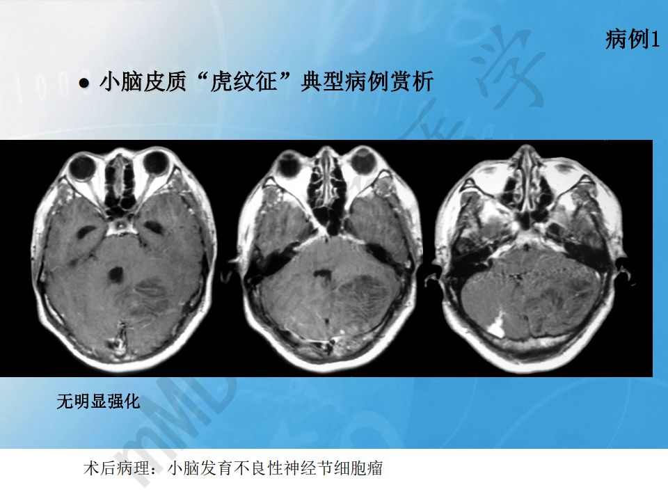 【PPT】小脑皮质“虎纹征”