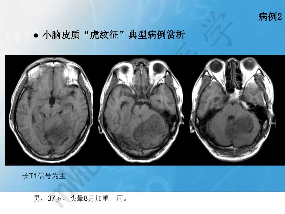 【PPT】小脑皮质“虎纹征”