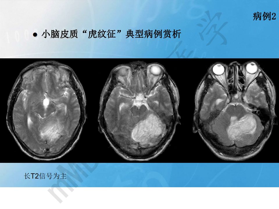 【PPT】小脑皮质“虎纹征”