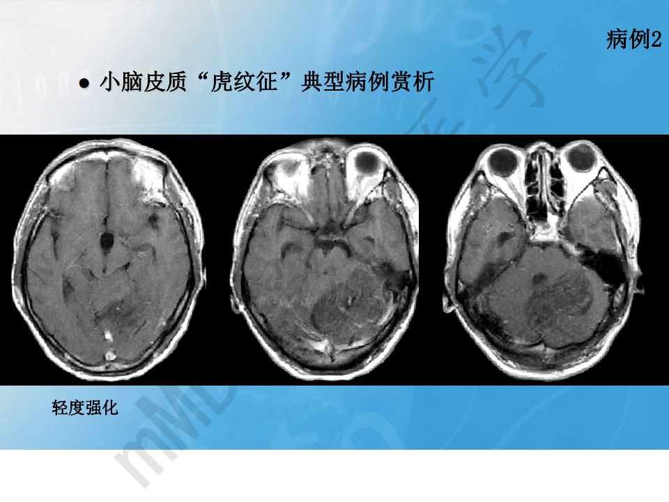 【PPT】小脑皮质“虎纹征”