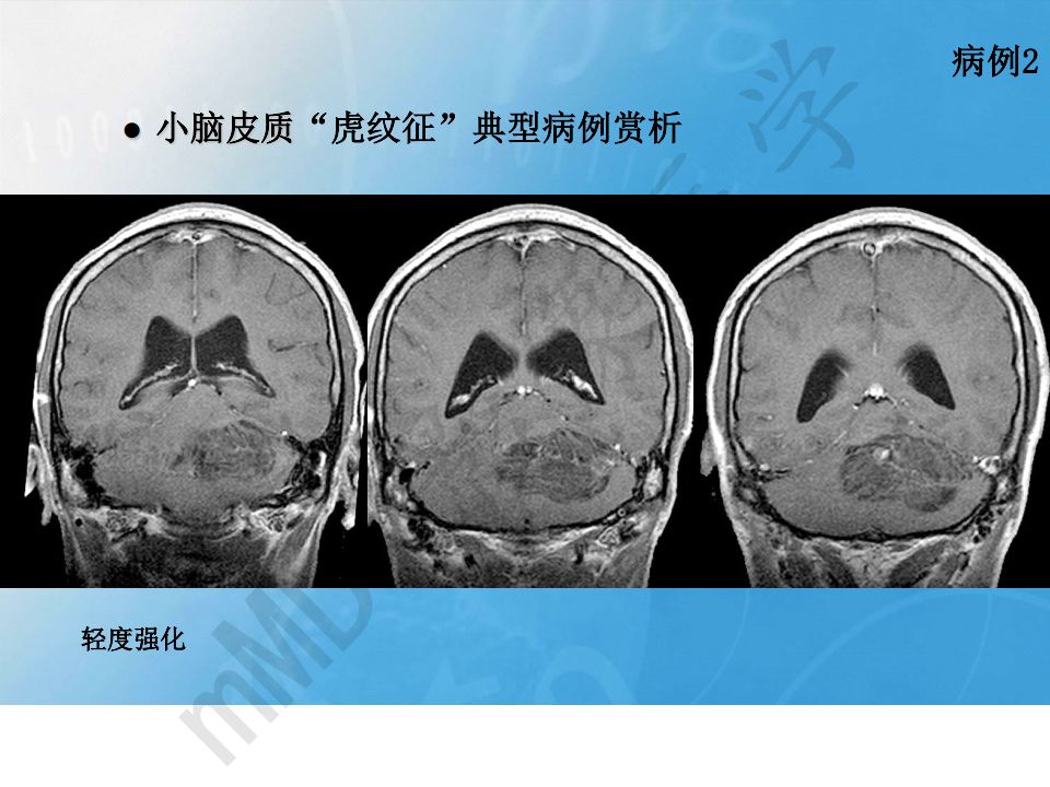 【PPT】小脑皮质“虎纹征”