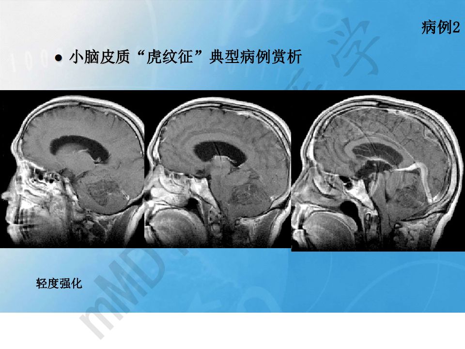 【PPT】小脑皮质“虎纹征”