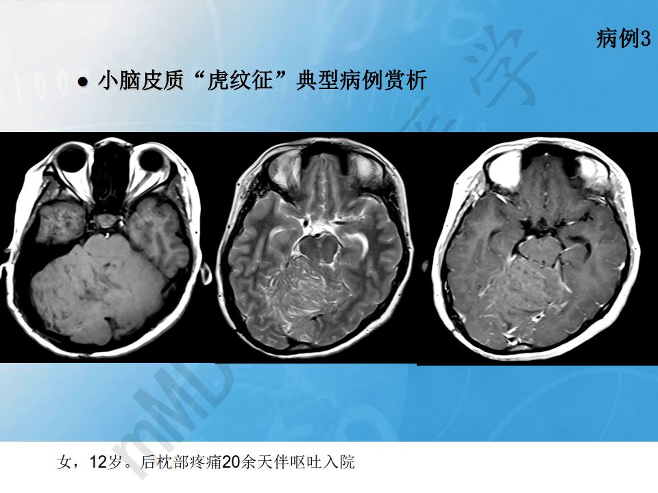 【PPT】小脑皮质“虎纹征”