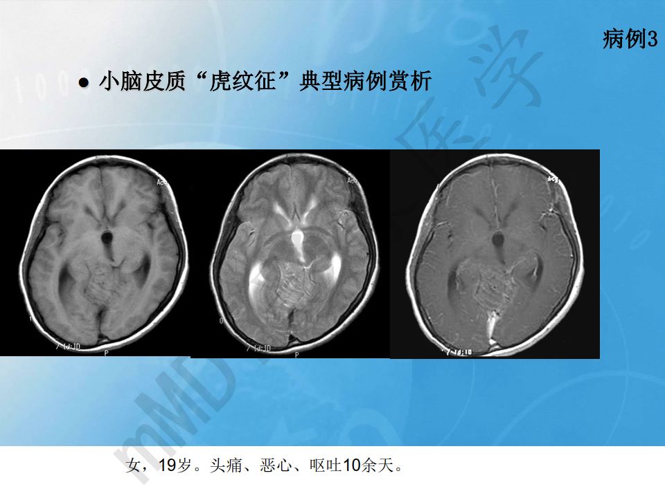 【PPT】小脑皮质“虎纹征”